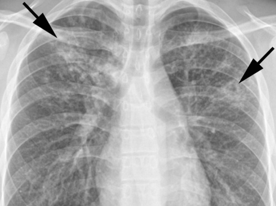 Pulmonary Tuberculosis