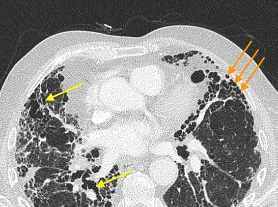 biopsies