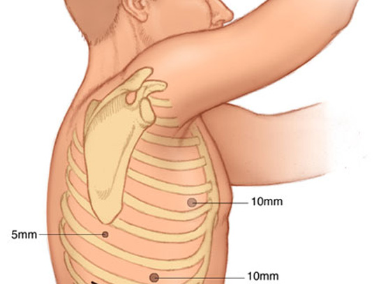 Esophageal Surgery