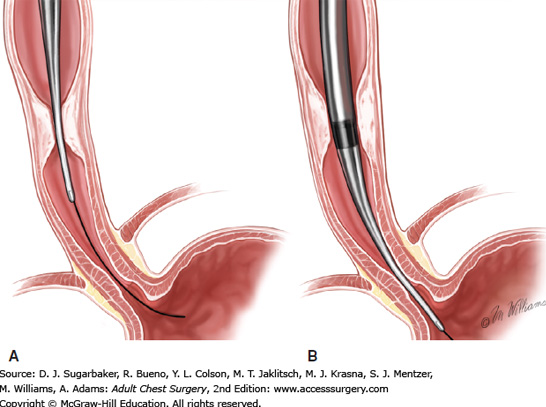 Esophageal Surgery