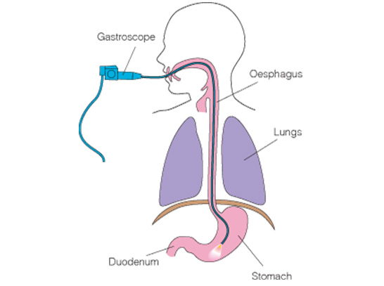 gastroscopy