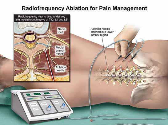 Radio Frequency